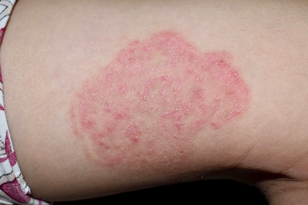 Грибок на коже: предотвращение и лечение